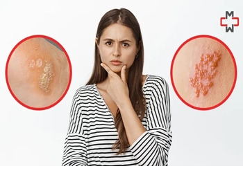 زگیل تناسلی چیست و چگونه تشخیص ودرمان نمود؟