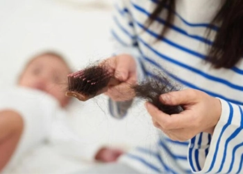 علت ریزش مو بعد از زایمان