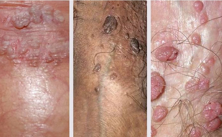 زگیل تناسلی چیست و چگونه تشخیص ودرمان نمود؟