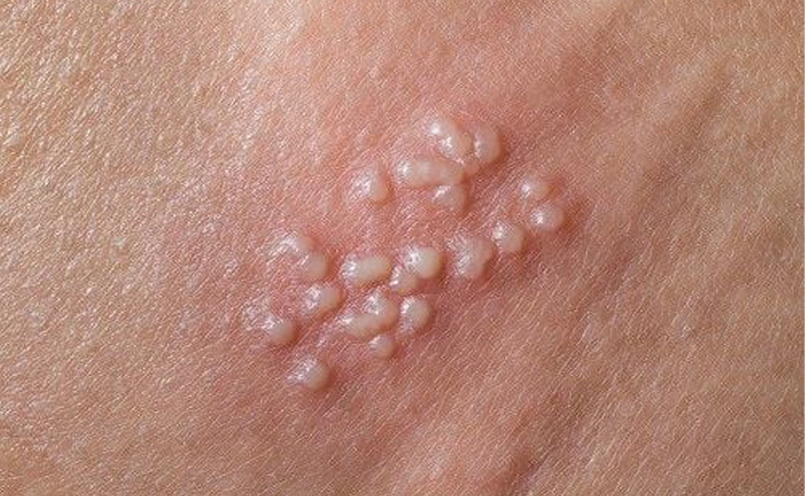 زگیل تناسلی چیست و چگونه تشخیص ودرمان نمود؟